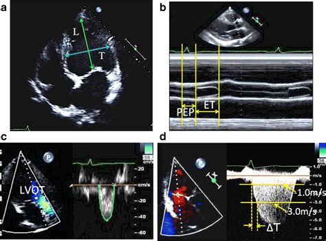 sphericity index echocardiography.